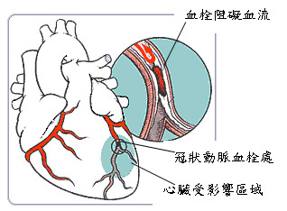 心臟病發作危險徵兆圖片