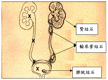 結石病人飲食注意事項圖片